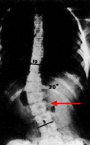 Scoliosis Scoliosis (15).gif